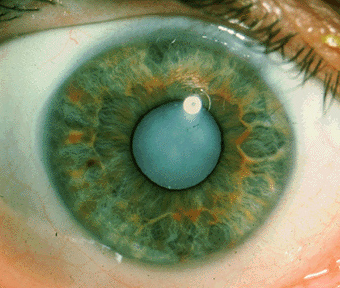Популярные витаминные БАДы реально защищают от катаракты